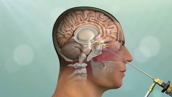 Endoscopic Skull Base Surgery
