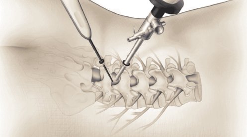 Minimally Invasive Spine Surgery Cost in Bangalore