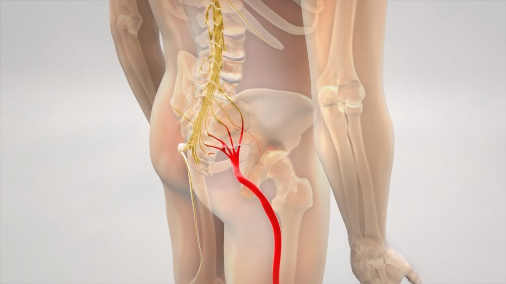 Pinched Nerve in Lower Back