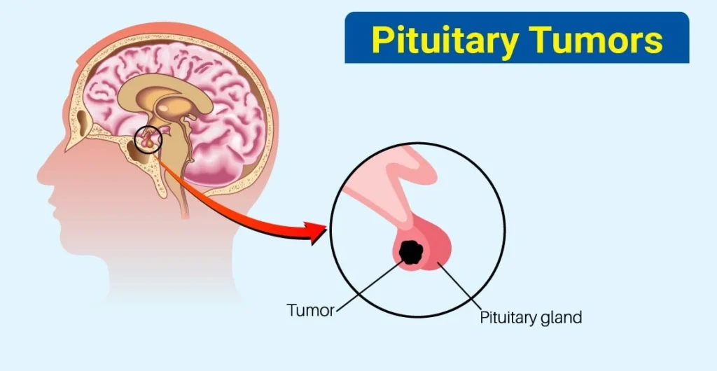 Pituitary Tumors