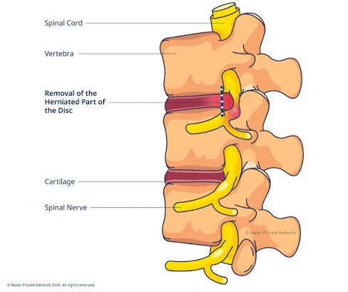 Slipped Disc