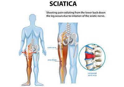 Leg Pain from Disc Prolapse